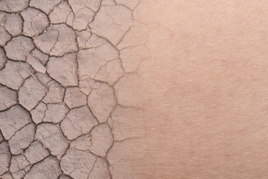 DAI o Dermatitis Asociada a la incontinencia urinaria
